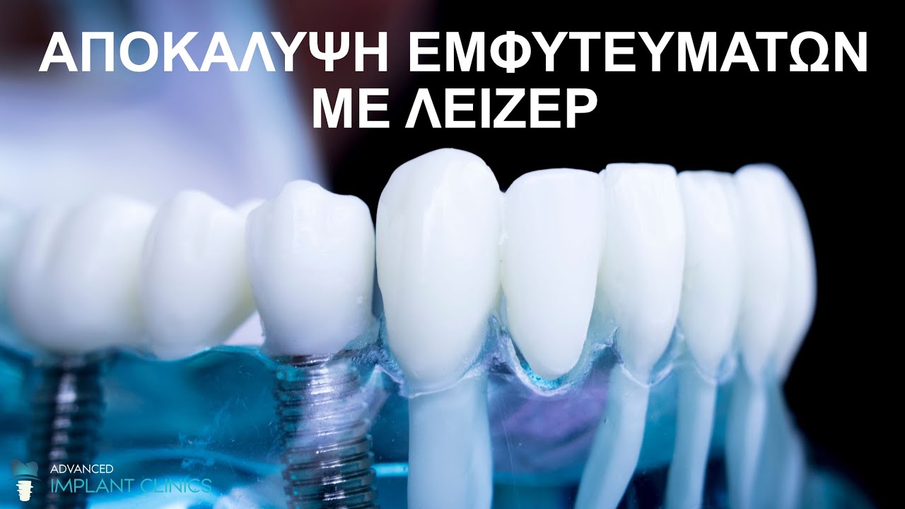 Αποκάλυψη εμφυτεύματος με λέιζερ - Biolase Laser