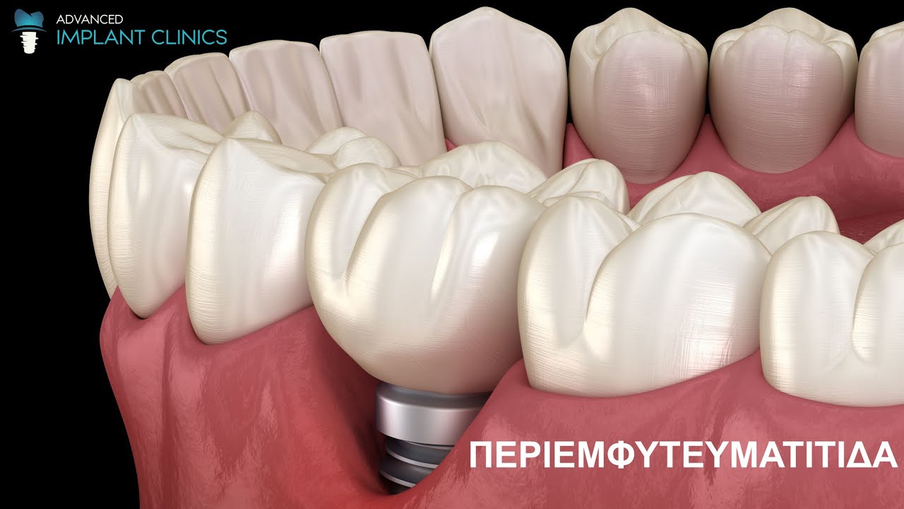 Θεραπεία περιεμφυτευματίτιδας με λέιζερ - Biolase Laser